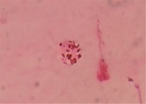 Toxoplasma Gondii Bradyzoites And Tachyzoites Isolation From Vitreous