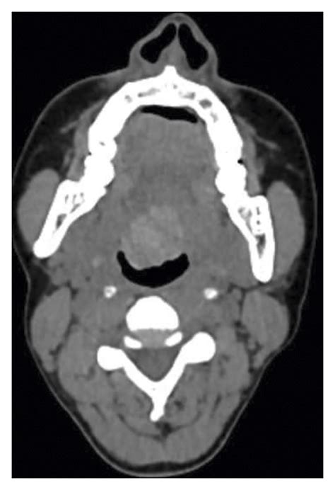 Lingual Thyroid With Subclinical Hypothyroidism In A Young Female