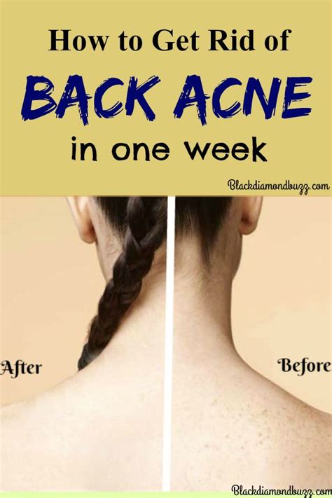 Back Acne Remedies How To Get Rid Of Acne On Back Fast At Home Back