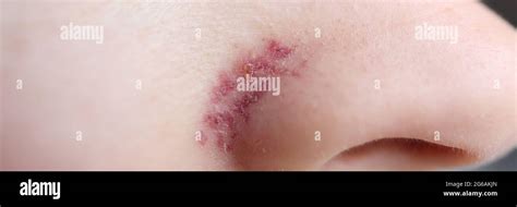 Closeup Of Red Inflamed Rash On Womans Nose Stock Photo Alamy