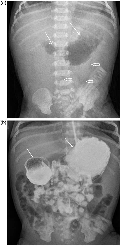 A Case Of A Newborn With An Intrahepatic Congenital Portosystemic