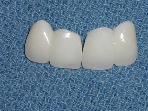 Zirconia - Porcelain Crowns - Dr. Caputo | Palm Harbor Dentist