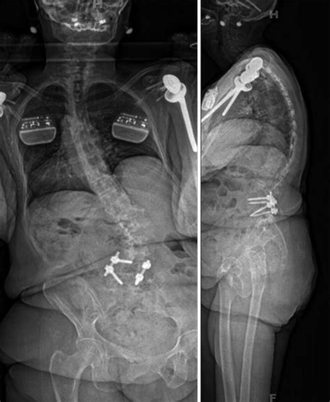 Patient Reported Outcomes Following The Treatment Of Adult Lumbar Scoliosis Musculoskeletal Key
