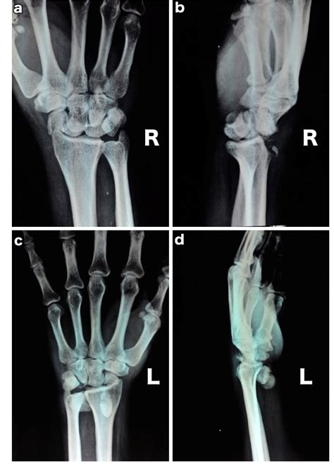 Figure From A Unique Case Of Bilateral Trans Scaphoid Perilunate Dislocation With Dislocation