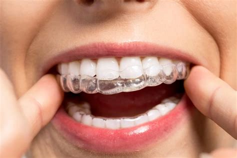 What No One Tells You About Invisalign PSS Herts