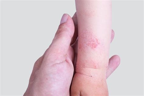 Dermatite At Pica O Que Sintomas Causas E Tratamento Tua Sa De