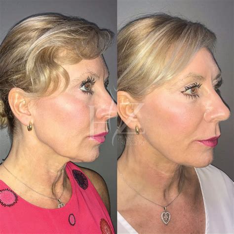 Face Lift Before And After Hz Plastic Surgery In 2021 Facelift Face