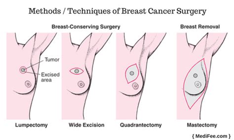 We did not find results for: Surgery for Breast Cancer: Treatments, Methods and Side ...