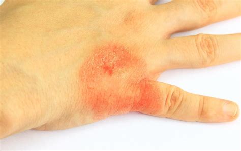 Skin Rash On Hand Khbuzz