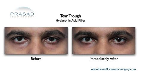 Under Eye Filler Before And After Photos Prasad Cosmetic Surgery Ny