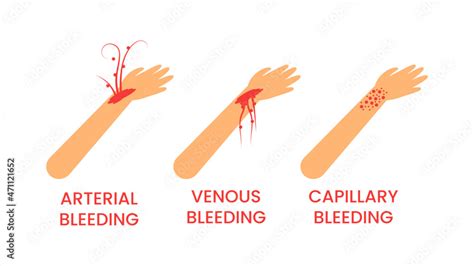 Abstract Flat Doctor Help Types Of Bleeding Venous Arterial Capillary
