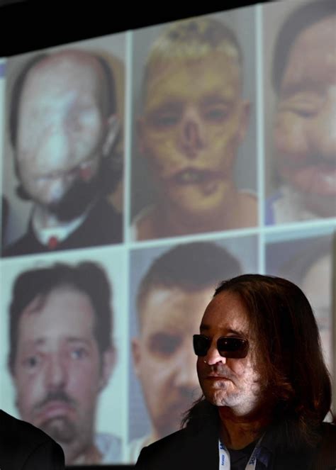 First Full Face Transplant Patient In Us Thrives Two Years Later Ny