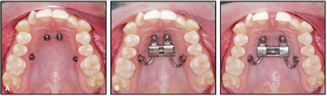 Bone First Principle With Cad Cam Insertion Guides For Mini Implant Assisted Rapid Palatal