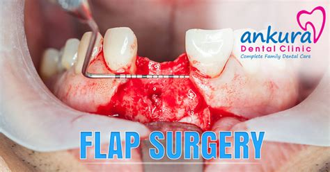 Gingival Flap Surgery - Symptoms, Preparation& Treatment