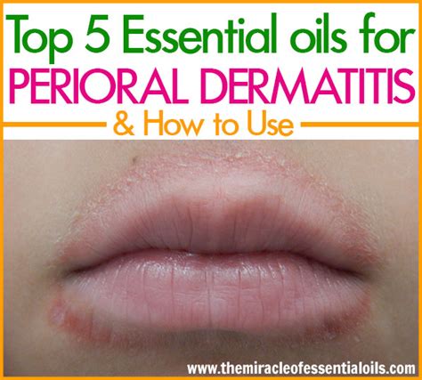 Top 5 Essential Oils For Perioral Dermatitis And How To Use Them For