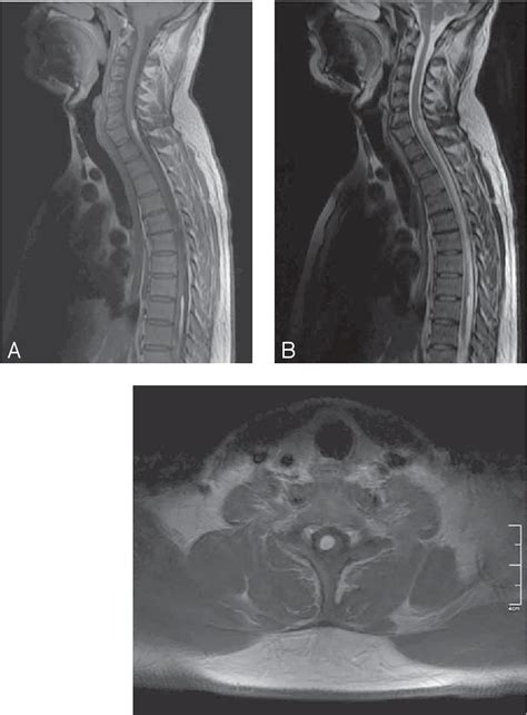 Figure 1 From Intramedullary Lipoma Of The Cervico Thoracic Spinal Cord