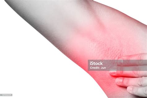 Female Armpit With Redness Skin Irritation Or Swollen Lymph Node Stock