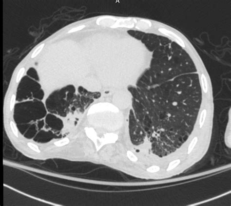Curable Cancer A Case Of Pulmonary Actinomycosis Imitates As Lung Cancer