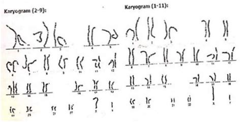 Karyotype Mosaic Trisomy 13 Download Scientific Diagram