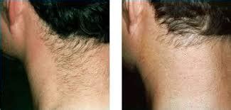 Laser hair removal neck before and after. Hair Removal, Hirsutism, Treatment Options