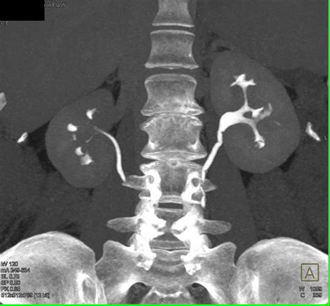 Papillary Necrosis Best Seen On 3d Images Kidney Case Studies