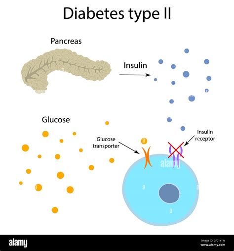 Type 2 Diabetes Mellitus Hi Res Stock Photography And Images Alamy