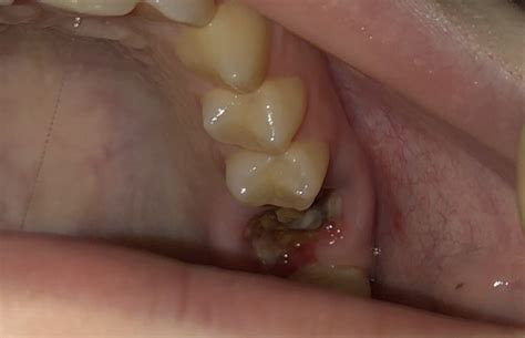 Possible Infection After Wisdom Tooth Removal And Biopsy