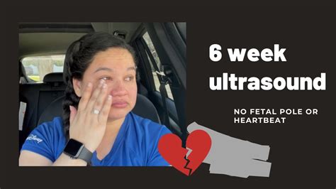 6 Week Ultrasound No Fetal Pole Or Heartbeat 💔 My Surrogacy Journey