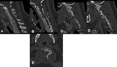 A Midline Sagittal Computed Tomography Ct Of The Cervical Spine