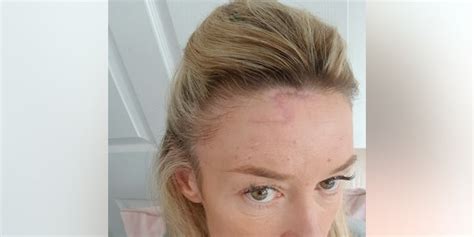 Woman Left With Harry Potter Scar After Skin Cancer Removed From