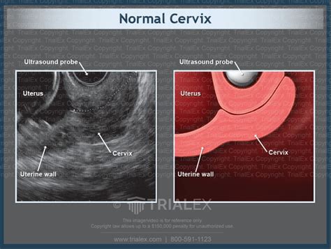 Ultrasound Of Normal Cervix Trial Exhibits Inc