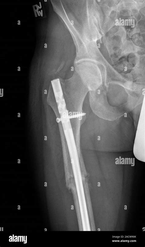 Pinned Femur Fracture X Ray Of A Titanium Metal Rod And Screw White