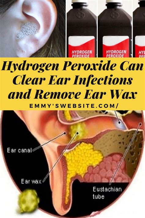 Now that you are aware of the possible side effects that can occur after using hydrogen peroxide for cleaning the ear, here are some alternative. Hydrogen Peroxide Can Clear Ear Infections and Remove Ear ...