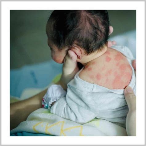 What Is Newborn Rash Photos And Facts Purely Postpartum