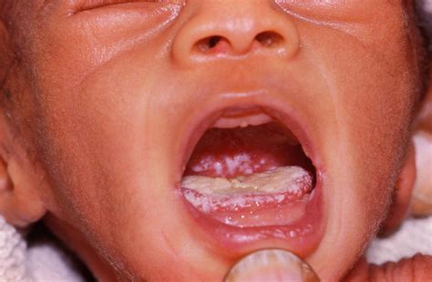 Oral Thrush In Aids Baby Photograph By Dr Ma Ansaryscience Photo