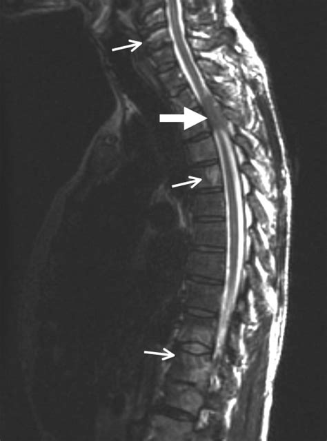 Mri Without Contrast Showing T3 Cord Compression By A S Open I