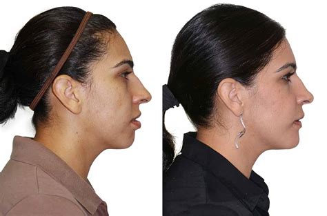 Face Asymmetry And Bite Correction Orthognathic Case Corrective Jaw