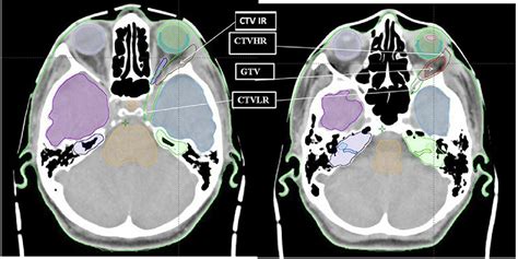 Frontiers Adenoid Cystic Carcinoma Of The Lacrimal Gland High Dose