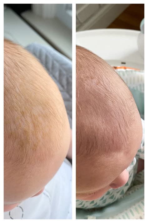 Cradle Cap Before And After Lovely Lucky Life