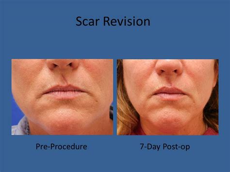 Scar Revision Before And After Photos Connecticut