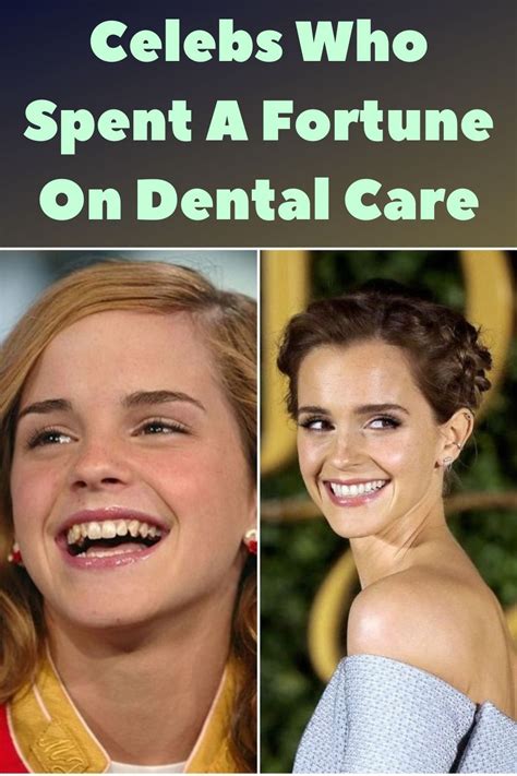 75 Drastic Transformations Of People Before And After Braces Artofit
