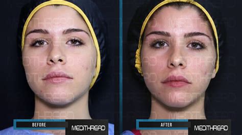 A thread lift is a safe and effective treatment, taking less than 60 minutes. PDO-THREAD LIFT TUTORIAL BY MEDiTHREAD - BROW LIFT - YouTube