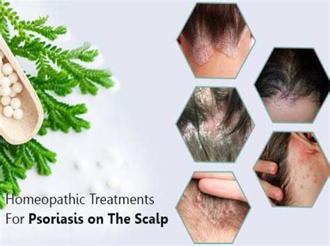 Remedies For Scalp Psoriasis There Are Over 200 Remedies In Homeopathy