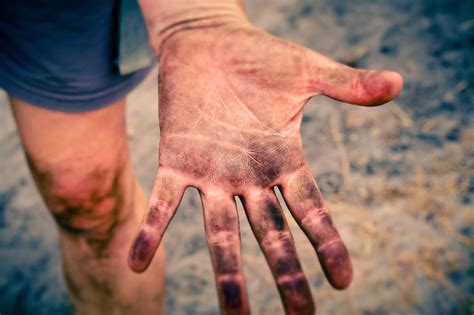 Three Most Common Hand Injuries Occupational Therapy