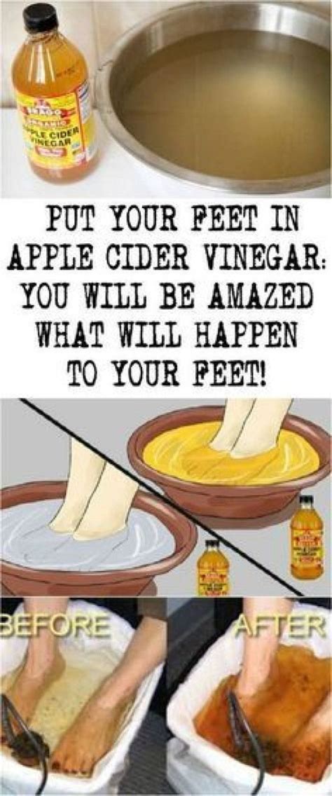 Put Your Feet In Apple Cider Vinegar You Will Be Amazed What Will