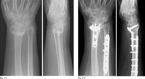 Figure 1 From Clinical Outcomes Of Corrective Osteotomy For Distal