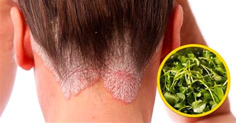Este afeta principalmente os dedos e também as unhas das mãos e dos pés, que crescem de forma anormal, ficam amareladas ou até mesmo sem coloração. Remédios caseiros para Psoríase - Tua Saúde