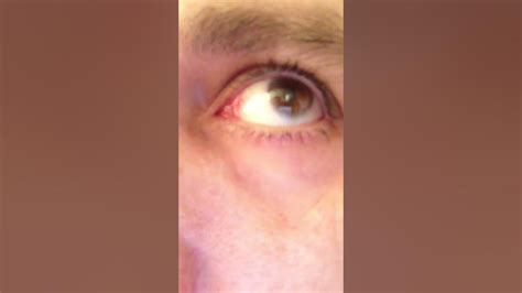 Eye Lens Flicker After Cataract Surgery Dysphotopsia Youtube