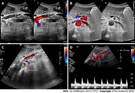 diagnosis of spontaneous isolated superior mesenteric artery dissection with ultrasound a case