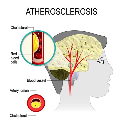 Cerebral Artery With Atherosclerosis Stock Vector Illustration Of
